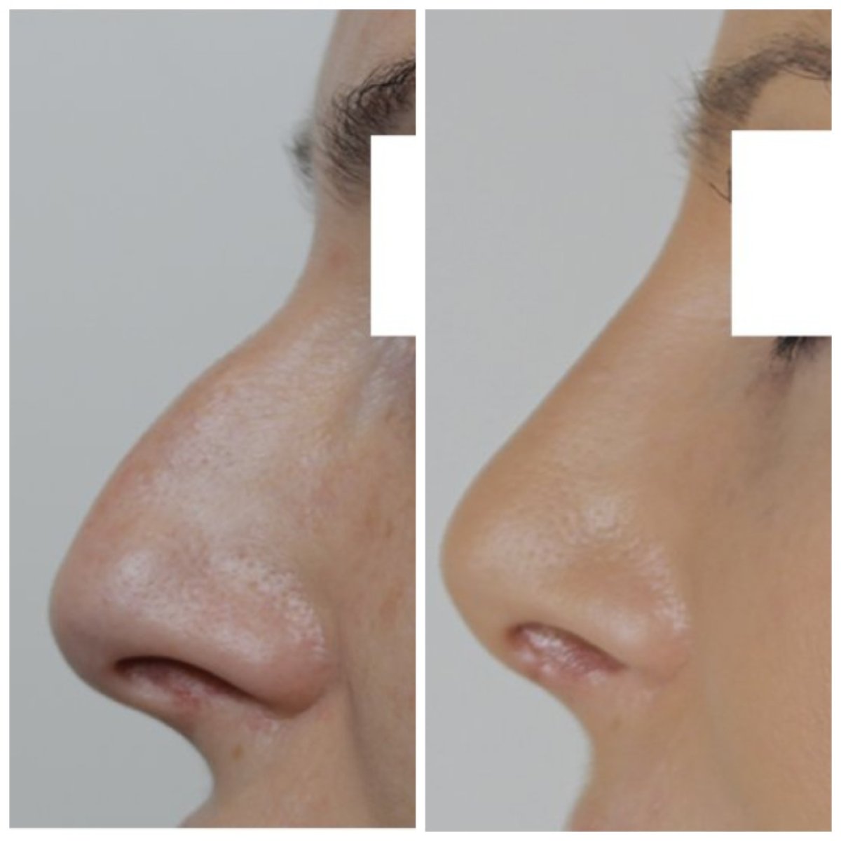 نتائج عملية تجميل الأنف قبل وبعد في Klinika La Perla، إعادة تشكيل طبيعية للأنف