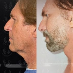 before-after photo tightening-of-facial-skin-facelift