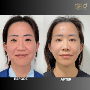 before-after photo glubokaya-podtyazhka-lica-deep-plane-facelift