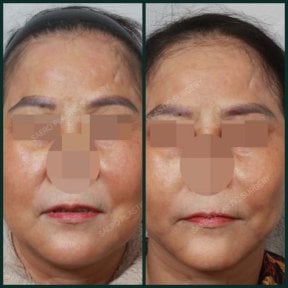 before-after photo podtazka-lba
