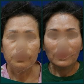 before-after photo podtazka-lba