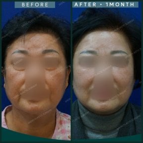 before-after photo podtazka-lba