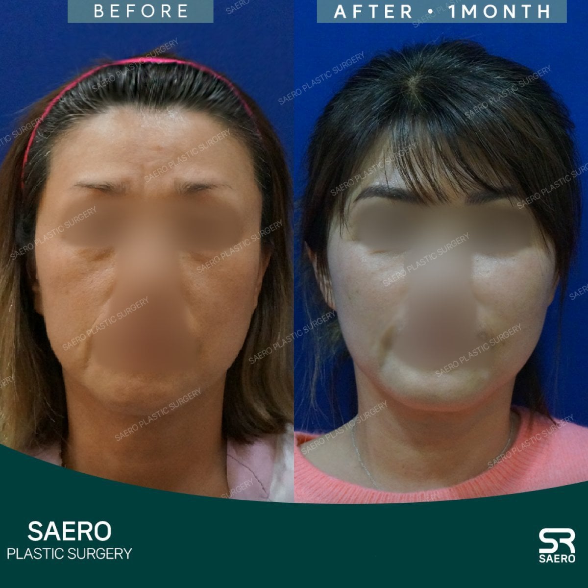نتائج شد الجبهة قبل وبعد في SAERO Plastic Surgery، رفع واضح للحاجبين