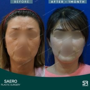 before-after photo podtazka-lba