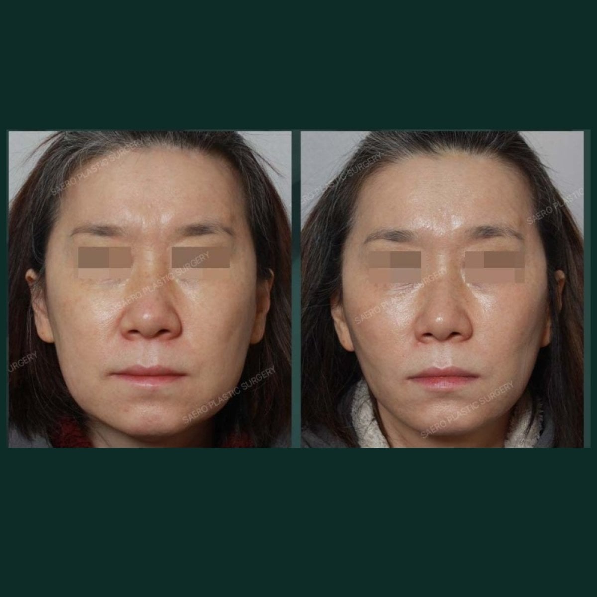 Resultados de contorno facial antes y después en SAERO Plastic Surgery, simetría mejorada