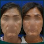 نتائج تحديد ملامح الوجه قبل وبعد في SAERO Plastic Surgery – تحسين تناسق الوجه