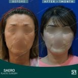 نتائج قبل وبعد تحديد ملامح الوجه في SAERO Plastic Surgery، تناظر محسّن للوجه