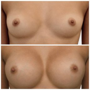before-after photo breast-augmentation