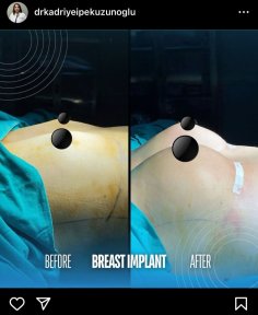 before-after photo rhinoplasty-nose-job