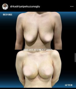 before-after photo rhinoplasty-nose-job