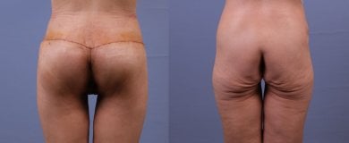before-after photo brazilian-butt-lift