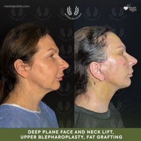 before-after photo deep-plane-facelift