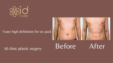 before-after photo vaser-liposuction