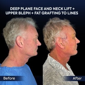 before-after photo tightening-of-facial-skin-facelift