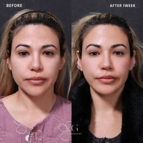 before-after photo revision-rhinoplasty
