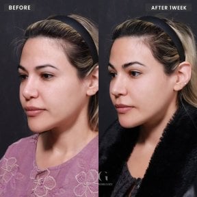 before-after photo revision-rhinoplasty