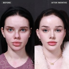 before-after photo revision-rhinoplasty