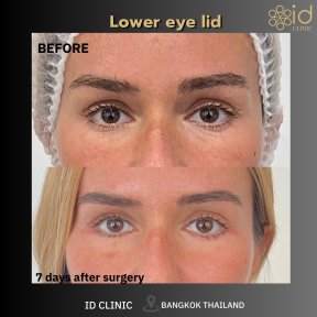 Результаты блефаропластики нижних век до и после в ID Clinic Bangkok, 7 дней после