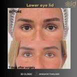 Результаты блефаропластики нижних век до и после в ID Clinic Bangkok, 7 дней после