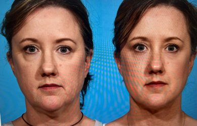 before-after photo liposuction