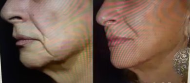 before-after photo liposuction