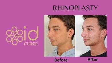 before-after photo rinoplastika-plastika-nosa