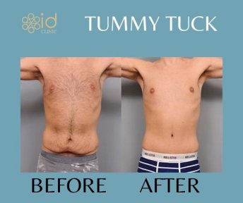 before-after photo abdominoplasty