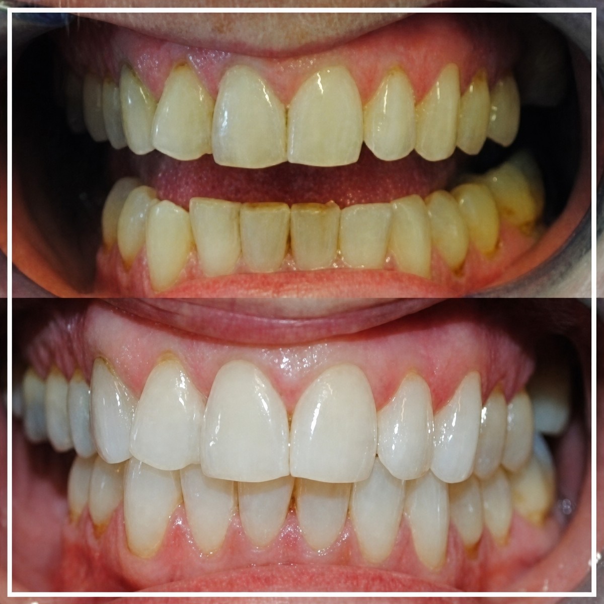 نتائج تنظيف الأسنان قبل وبعد (تقشير) في SoftDentalCare Clinic، ابتسامة أكثر بياضًا