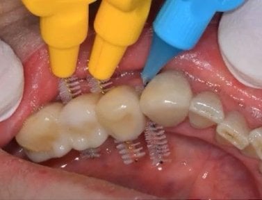 before-after photo teeth-cleaning
