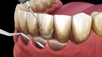 before-after photo teeth-cleaning