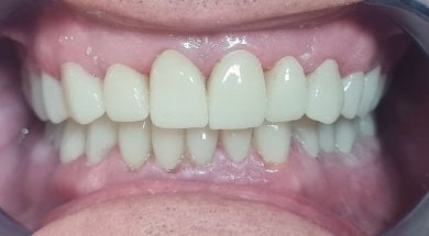 before-after photo teeth-cleaning
