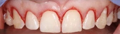 before-after photo teeth-cleaning