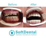 نتائج قبل وبعد تركيب أطقم الأسنان في SoftDentalCare Clinic، ابتسامة محسنة