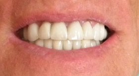 نتيجة تركيب أطقم الأسنان في SoftDentalCare Clinic – ابتسامة طبيعية مستعادة