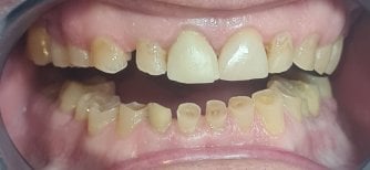 تحضير الأسنان لتركيب الأطراف الصناعية في عيادة SoftDentalCare، مرحلة العلاج