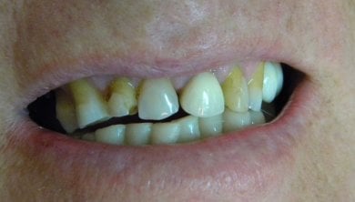 قبل تركيب أطقم الأسنان في عيادة SoftDentalCare، تظهر الأسنان التالفة