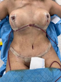 Liposuction and breast lift post-op result at Memorial Bahçelievler Hospital, visible contour change