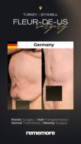 Before and after Fleur-de-Lis surgery result at Memorial Bahçelievler Hospital, body contouring