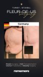 Before and after Fleur-de-Lis surgery result at Memorial Bahçelievler Hospital, body contouring