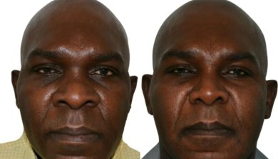 before-after photo korrekciya-shirokogo-nosa