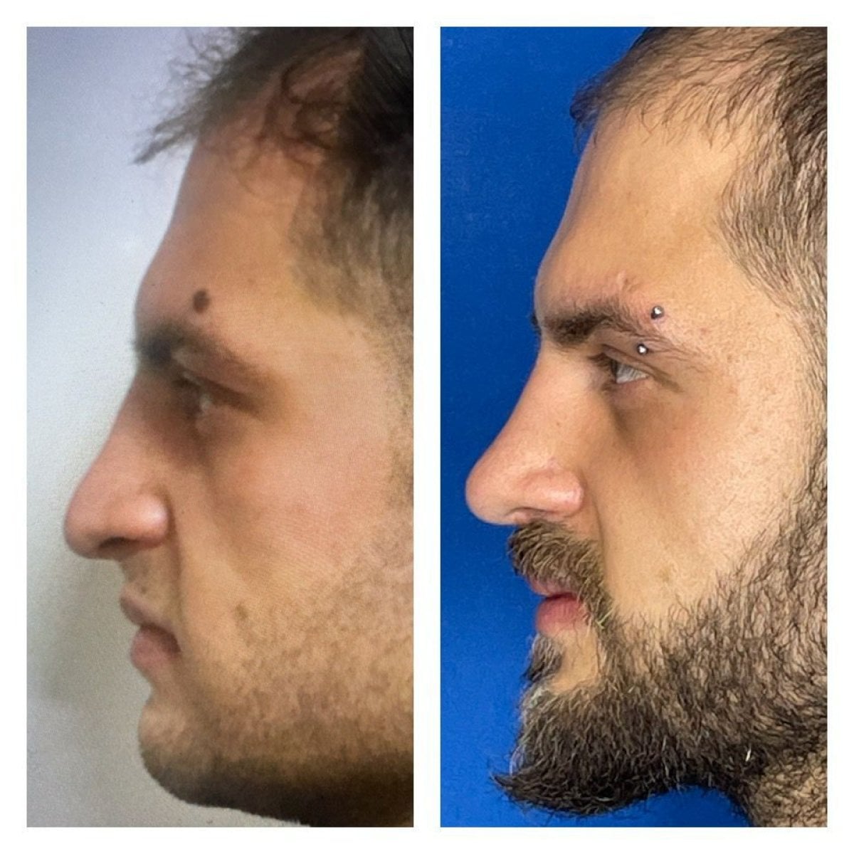 نتائج تجميل الأنف المنتفخ قبل وبعد في مستشفى ميموريال أنطاليا، تحسين شكل الأنف