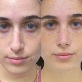 نتائج تجميل الأنف قبل وبعد في مستشفى Memorial Bahçelievler، إعادة تشكيل الأنف