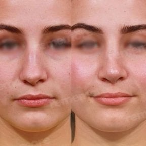 Before and after rhinoplasty results at Memorial Bahçelievler Hospital, nose reshaping
