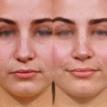Before and after rhinoplasty results at Memorial Bahçelievler Hospital, nose reshaping