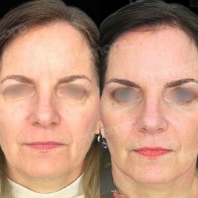 Before and after deep plane facelift results at Memorial Bahçelievler Hospital, facial rejuvenation