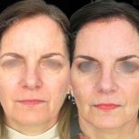 Before and after deep plane facelift results at Memorial Bahçelievler Hospital, facial rejuvenation