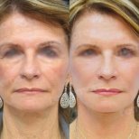 Before and after deep plane facelift results at Memorial Bahçelievler Hospital, facial rejuvenation