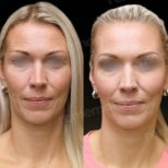 Before and after deep plane facelift results at Memorial Bahçelievler Hospital, facial rejuvenation