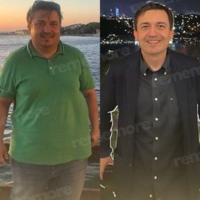 نتائج قبل وبعد جراحة تحويل مسار المعدة في مستشفى ميموريال غوزتيبي، فقدان وزن ملحوظ