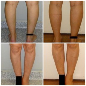 Antes y después de implantes de pantorrilla en Memorial Göztepe Hospital – mejor contorno